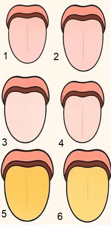 تشخیص انواع بیماری ها با بررسی زبان - رد دندان روی زبان نشانه چیست؟