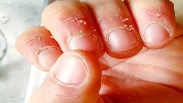دلیل پوست پوست شدن اطراف ناخن و روش های درمان
